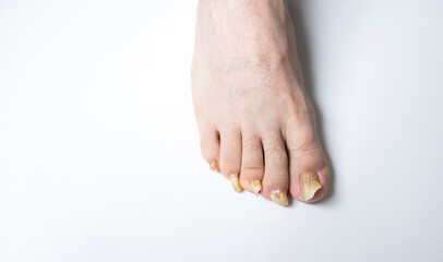 Man's Feet with Long Nails Infected by Fungus