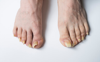 Man's Feet with Long Nails Infected by Fungus