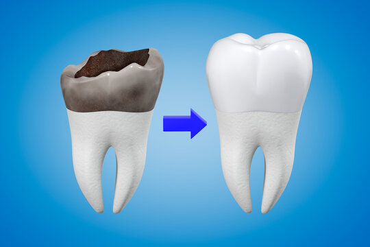 The concept of prosthetics for a damaged tooth with a metal-ceramic crown. Carious tooth and dental crown. 3d rendering.