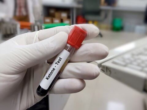 Biochemist or doctor holds blood sample for Ketone test, diagnosis of diabetic ketoacidosis. Medical test tube in laboratory background.