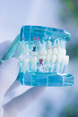 Tooth decay dental model