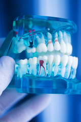 Tooth decay dental model