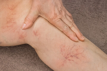 An elderly woman's hand touches her sick leg with vein thrombosis, varicose veins