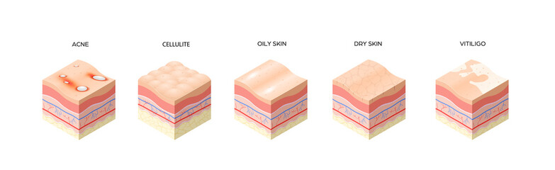 set different types skin layers cross-section of human skin structure skincare medical concept flat horizontal - obrazy, fototapety, plakaty