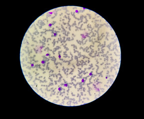 Microscopic view of cold agglutinin disease (CAD), autoimmune hemolytic anemia