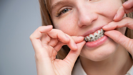 Close-up portrait of a red-haired girl touching braces. Young woman corrects bite with orthodontic appliance.