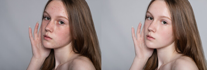 health, people, youth and beauty concept - Before and after cosmetic operation. Young pretty woman...
