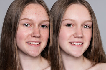 health, people, youth and beauty concept - Before and after cosmetic operation. Young pretty woman portrait. Before and after cosmetic or plastic procedure anti-age therapy, treatment
