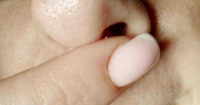 Woman with a herpes under her nose and a herpes sore. Smearing herpes with medicinal ointment. Macro