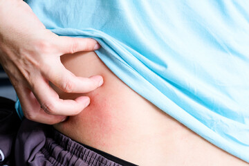 The man's hands he uses his hands to scratch his back because of dermatitis and itch sensation.