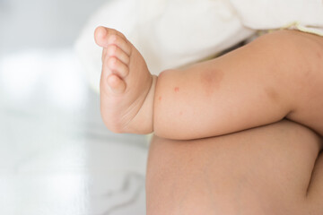 Infected itchy blisters on the legs of a child. Health concepts.