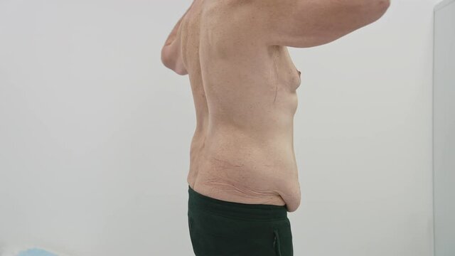 Dropping body of a male patient in clinic. Shirtless man showing his body with problem zones to the plastic doctor in clinic. Body after weight loss.
