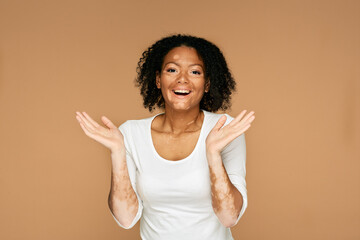 People with vitiligo. Positive woman with vitiligo and abnormal skin spots and wow emotions on her...