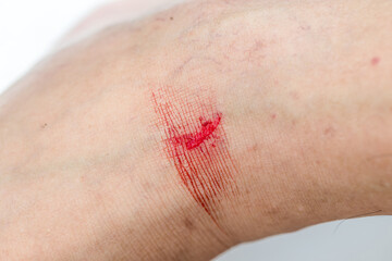 Fototapeta premium Injuries from falling in the garden. A man showing a lesion on his foot. Arm is wound from a knife. Figure cut on the skin with blood drops. Accident wound marks on the foot side