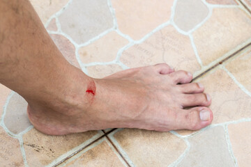 Injuries from falling in the garden. A man showing a lesion on his foot. Arm is wound from a knife....