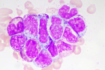 Chronic myeloid leukemia cells or CML, analyze by microscope, original magnification 1000x
