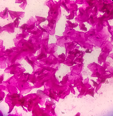 Microscopic view of high vaginal swab Gram stain smear, 10x. diagnosis of Bacterial vaginosis (BV)