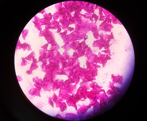Microscopic view of high vaginal swab Gram stain smear, 10x. diagnosis of Bacterial vaginosis (BV)