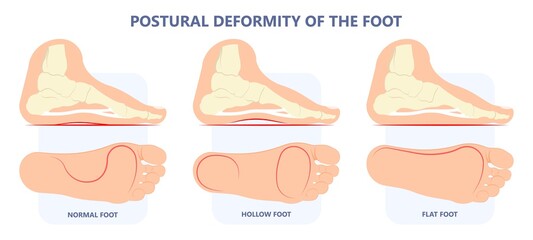 Plantar Fasciitis Heel pain run foot bone toes tear strain sport injury arch Shock Wave flat feet fallen pes planus Tendon tight hollow cavus high curved spur bony ankle band torn