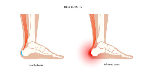 Bursitis inflammation concept - obrazy, fototapety, plakaty
