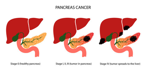 Pancreas disease and cancer - obrazy, fototapety, plakaty