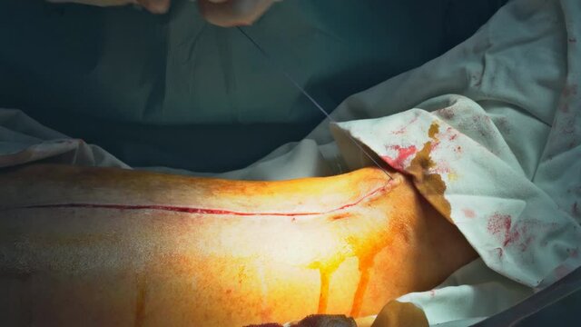 Leg after during surgery doctor suturing the patient on operating room