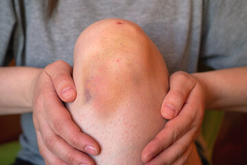 Bruise injury on knee. Close up image of person sitting on sofa and holding in hands wounded leg...