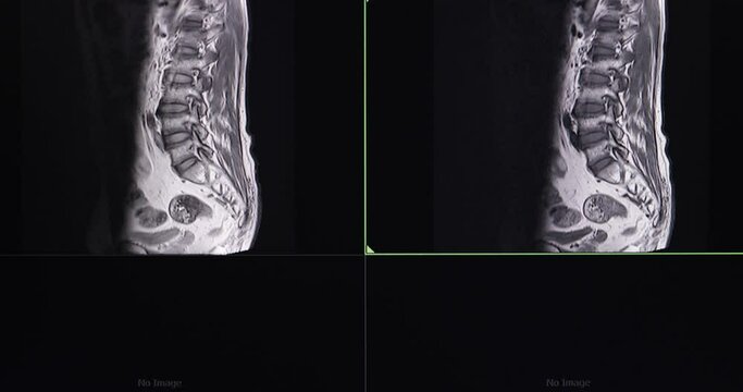 MRI scan of patient's lumbosacral spines.