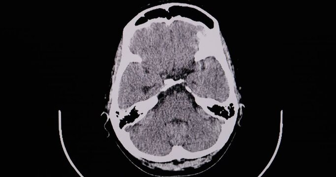 CT brain cine scan of a patient with left side hemiplegia showing large intracerebral hemorrhage and hematoma at right basal ganglia. Diagnostic CT footage.