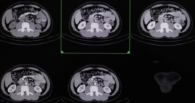 CT scan of a whole abdomen of a patient with testicular carcinoma.