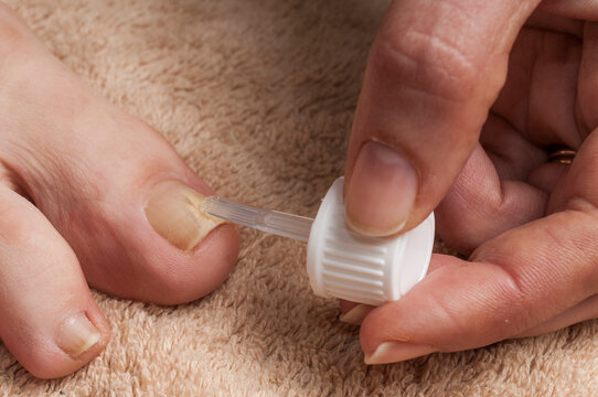 Woman applies treatment to cure toenail fungus (onychomycosis)