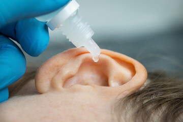 doctor dripping ear drops into patient ear. ear pain and clogged ears concept