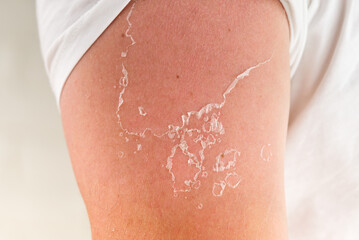 peeling of skin after burned by sunlight. not using sunscreen. sunburn of the skin
