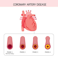 Coronary Artery Disease Narrowing Or Blockage Of Coronary Arteries, Condition Caused By Build-up Of Cholesterol And Fatty Inside Arteries