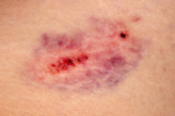 Close-up on the bruise on the skin of the leg of an injured woman. Close up on a bruise on the skin of an injured woman's leg. Gender Violence Concept - obrazy, fototapety, plakaty