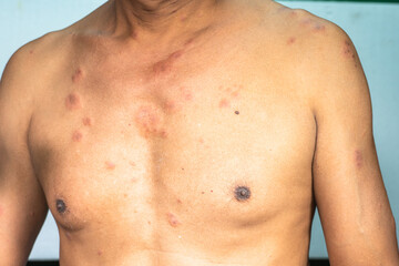 .A 60-year-old man has a blistering rash. There are lymphatic fluids all over the body. .after vaccination against the coronavirus. Caused by an allergic reaction to the COVID-19 vaccine..