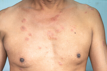 .A 60-year-old man has a blistering rash. There are lymphatic fluids all over the body. .after vaccination against the coronavirus. Caused by an allergic reaction to the COVID-19 vaccine..
