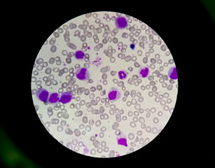 Microscopic view of cold agglutinin disease (CAD), autoimmune hemolytic anemia