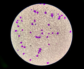 Microscopic view of cold agglutinin disease (CAD), autoimmune hemolytic anemia