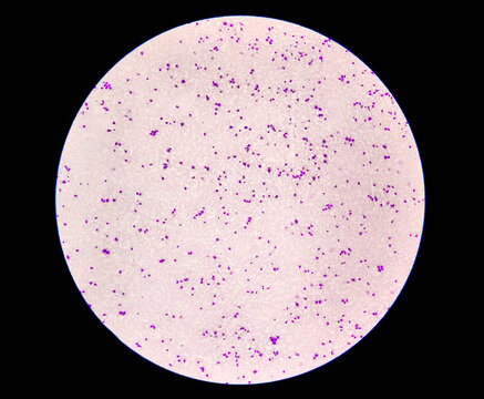 Acute myeloid leukemia (AML) is a type of blood cancer. Microscopic examination of blasts or leukemia cells in blood smear of human. 40x objective. closeup