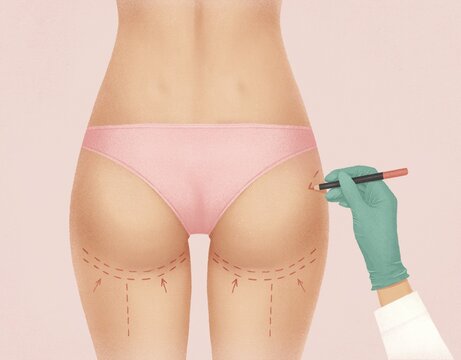 Surgeon drawing marks on female body before plastic operation.