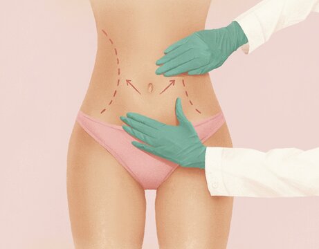 A surgeon examining a woman's body before plastic surgery. Liposuction concept