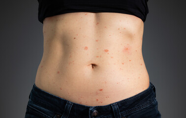 Naklejka premium Heat rash on stomach of woman. Fit female torso with prickly heat or miliaria from physical activity. Fluid-filled red blisters and bumps visible in different stages of healing. Dark background.