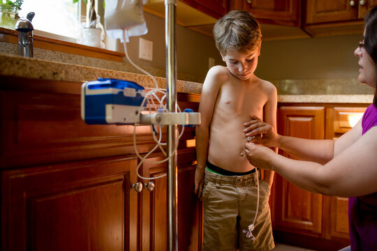Mother connects feeding pump  to child's gastric port in home kitchen 