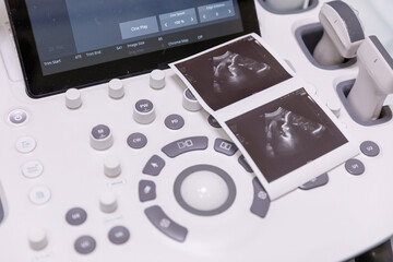 Sonogram scan of baby 