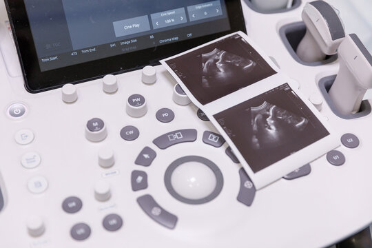 Sonogram scan of baby 