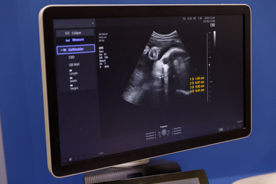 Sonogram scanning 