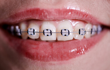 Horizontal close-up snapshot of beautiful woman's smile, demonstrating white healthy teeth with...