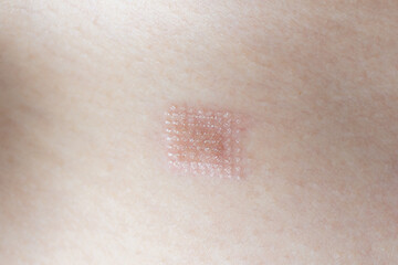 Marks after laser hair or scar removal from the skin. CO2 technique.