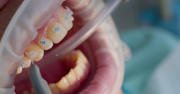 Close-up open mouth with optragate and on teeth are braces that cleaning by using water and saliva ejector.